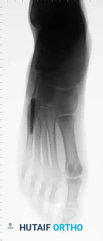 Fig. 86-45 A-C, Type IA (DeLee) ﬁ fth metatarsal fracture in collegiate soccer player. D-F, After ﬁ xation with variable pitch compression screw.