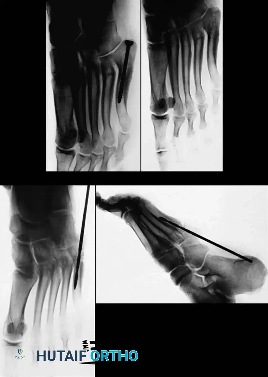 METATARSALS Surgical Diagram