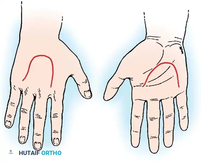 Methods and Indications for Skin Closure in Hand Surgery
