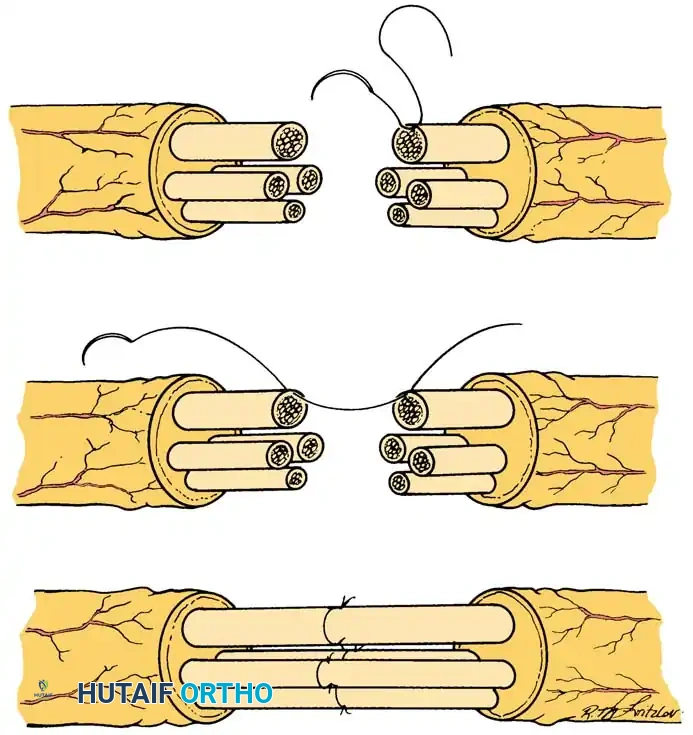 MICROSURGICAL TREATMENT OF NERVE INJURIES Surgical Diagram