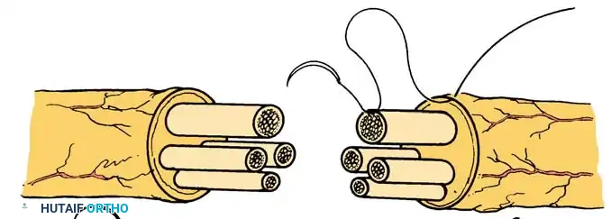 MICROSURGICAL TREATMENT OF NERVE INJURIES Surgical Diagram