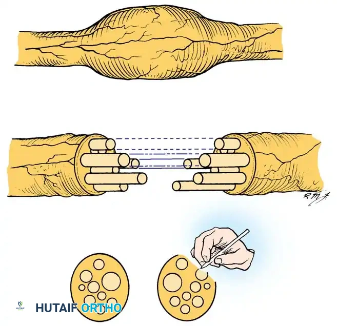 MICROSURGICAL TREATMENT OF NERVE INJURIES Surgical Diagram