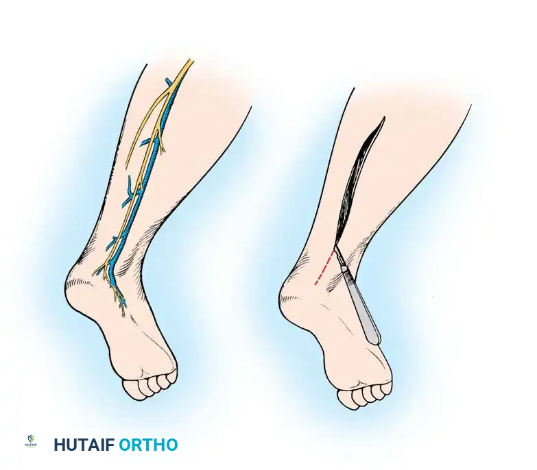 Lesser saphenous vein sural nerve
