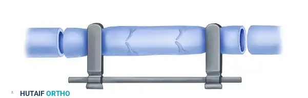 MICROVASCULAR END-TO-SIDE ANASTOMOSIS Surgical Diagram