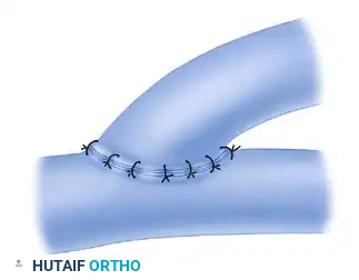 MICROVASCULAR END-TO-SIDE ANASTOMOSIS Surgical Diagram