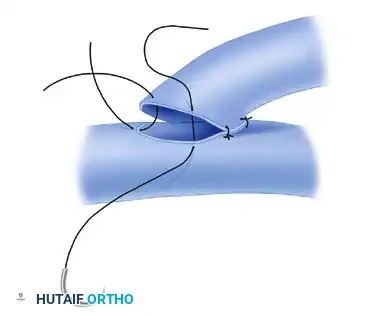 Mastering Microvascular End-to-Side Anastomosis and Vein Grafting