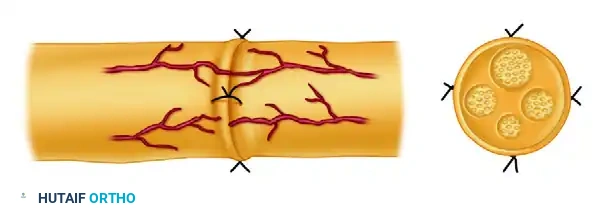 اكتمال خياطة العصب الدقيقة بدون أي شد لضمان التروية الدموية