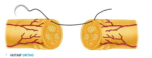 دليل المريض الشامل في جراحة إصلاح الأعصاب الدقيقة وترقيع الأوردة