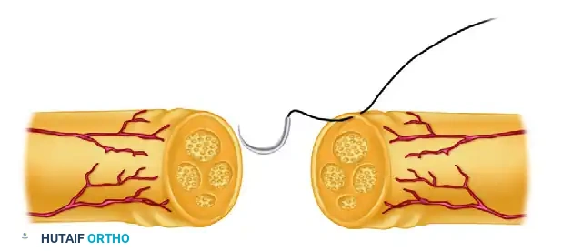 استخدام خيوط الجراحة للتحكم في دوران العصب أثناء العملية