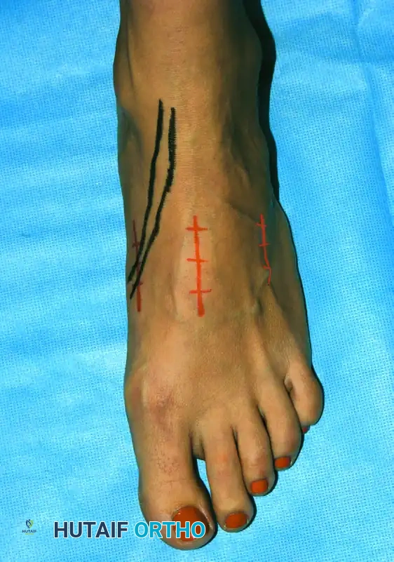 الدليل الشامل لعملية دمج مفاصل منتصف القدم