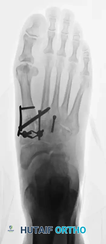 صورة شعاعية تظهر تثبيت العظام بالبراغي والشرائح