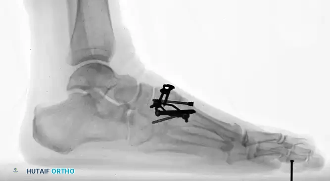 استخدام شريحة معدنية لتثبيت مفاصل منتصف القدم