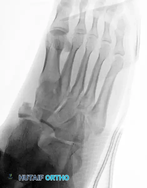 MIDFOOT FRACTURES AND DISLOCATIONS Surgical Diagram