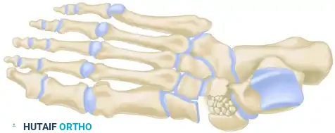 MIDFOOT FRACTURES AND DISLOCATIONS Surgical Diagram