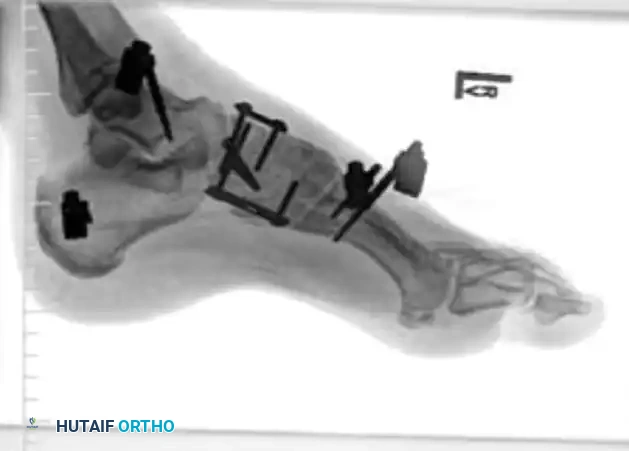 MIDFOOT FRACTURES AND DISLOCATIONS Surgical Diagram
