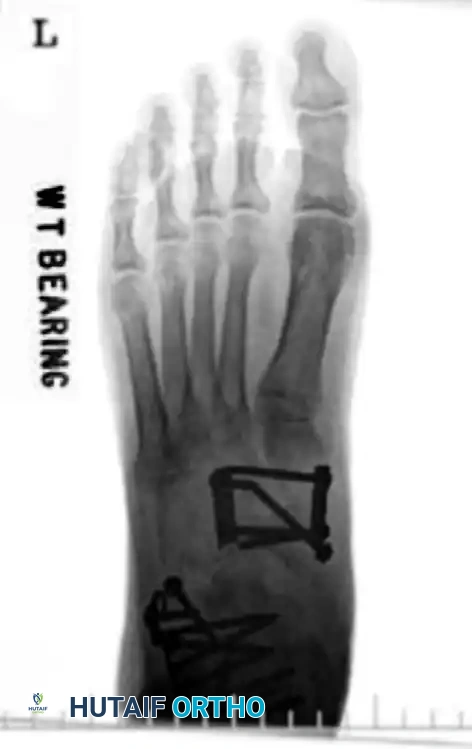 MIDFOOT FRACTURES AND DISLOCATIONS Surgical Diagram
