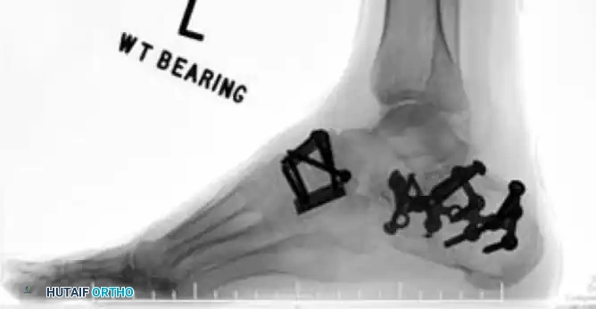 MIDFOOT FRACTURES AND DISLOCATIONS Surgical Diagram