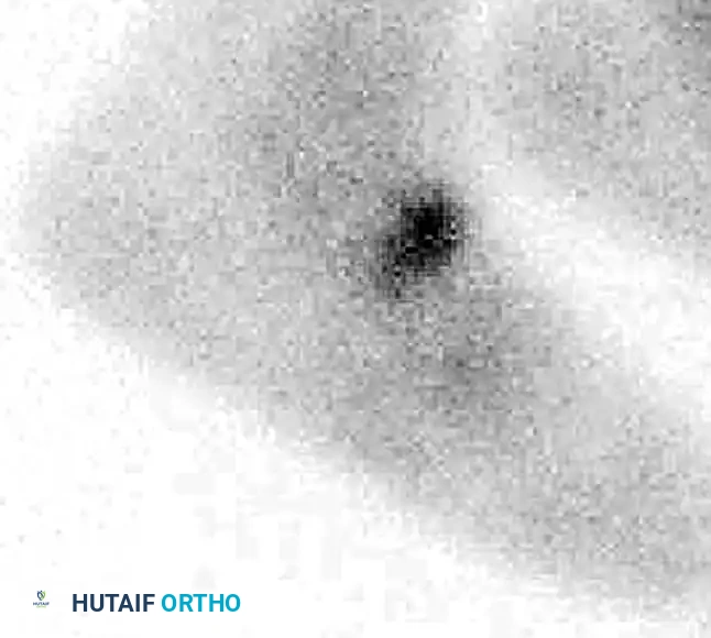 MIDFOOT FRACTURES AND DISLOCATIONS Surgical Diagram