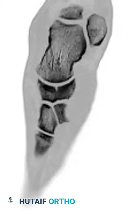 MIDFOOT FRACTURES AND DISLOCATIONS Surgical Diagram