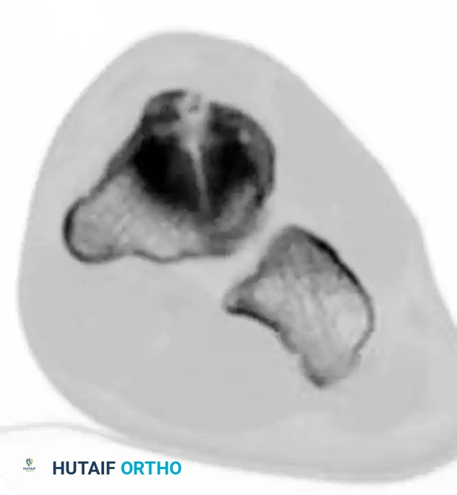 MIDFOOT FRACTURES AND DISLOCATIONS Surgical Diagram