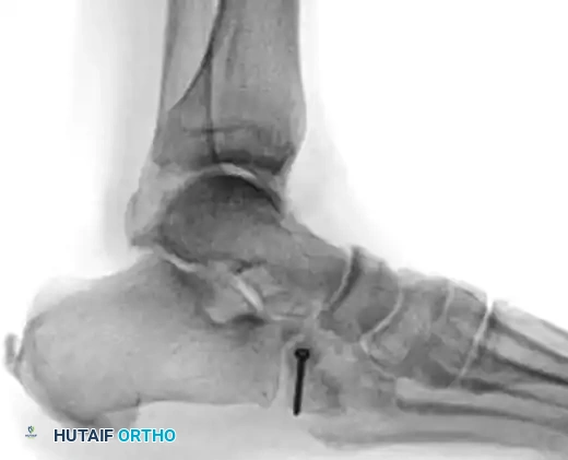 MIDFOOT FRACTURES AND DISLOCATIONS Surgical Diagram