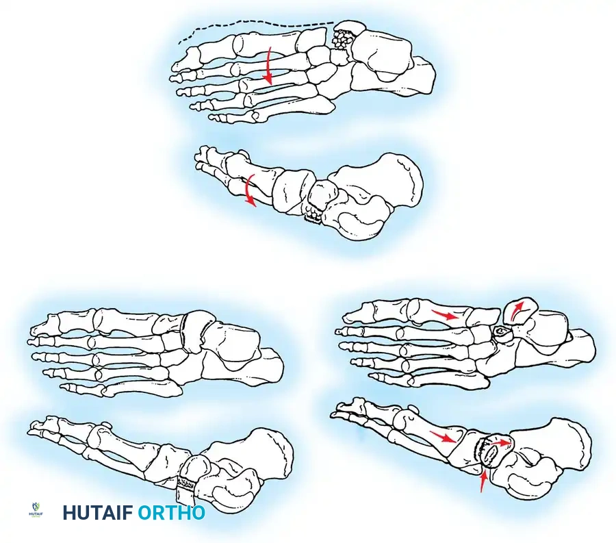 Midfoot Fractures and Dislocations: A Comprehensive Surgical Guide