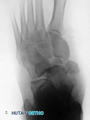 MIDFOOT FRACTURES AND DISLOCATIONS Surgical Diagram