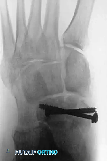 Fig. 86-36 Open reduction and internal ﬁ xation of type III navicular fracture. A and B, Preoperative radiographs. C, Semicoronal CT scan showing comminution of body of navicular. D and E, Postoperative radiographs.