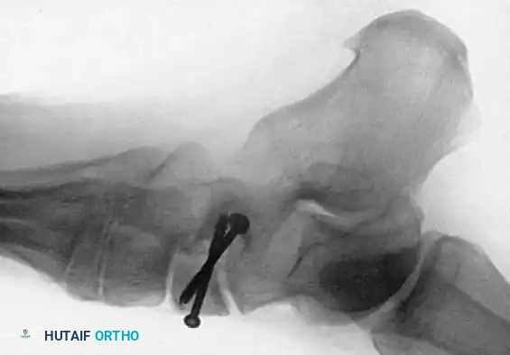 MIDFOOT FRACTURES AND DISLOCATIONS Surgical Diagram