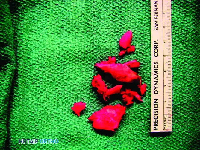 MIDSHAFT MALUNIONS OF THE CLAVICLE Surgical Diagram