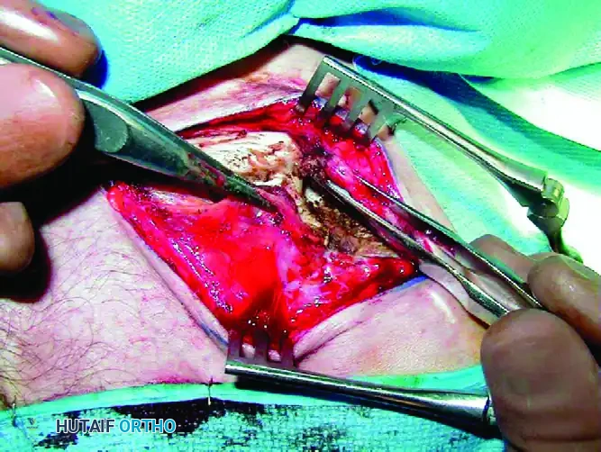 MIDSHAFT MALUNIONS OF THE CLAVICLE Surgical Diagram