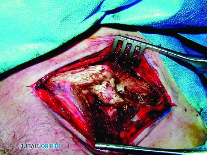 MIDSHAFT MALUNIONS OF THE CLAVICLE Surgical Diagram