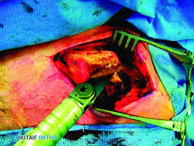 MIDSHAFT MALUNIONS OF THE CLAVICLE Surgical Diagram