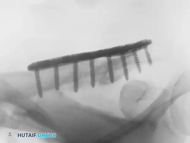 MIDSHAFT MALUNIONS OF THE CLAVICLE Surgical Diagram