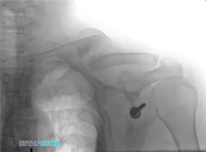 MIDSHAFT MALUNIONS OF THE CLAVICLE Surgical Diagram