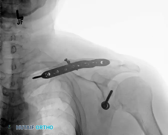 MIDSHAFT MALUNIONS OF THE CLAVICLE Surgical Diagram