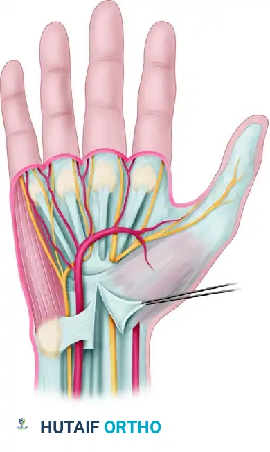 Mastering Carpal Tunnel Release: Mini-Palm, Open, and Endoscopic Techniques