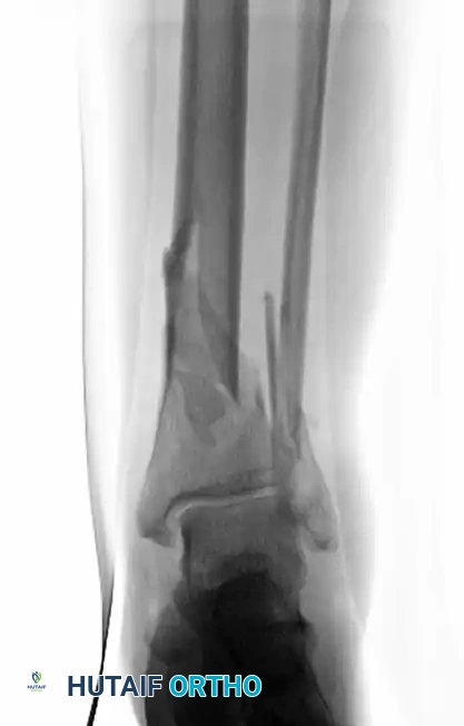 MINIMALLY INVASIVE PLATING OF TIBIAL PILON FRACTURE Surgical Diagram