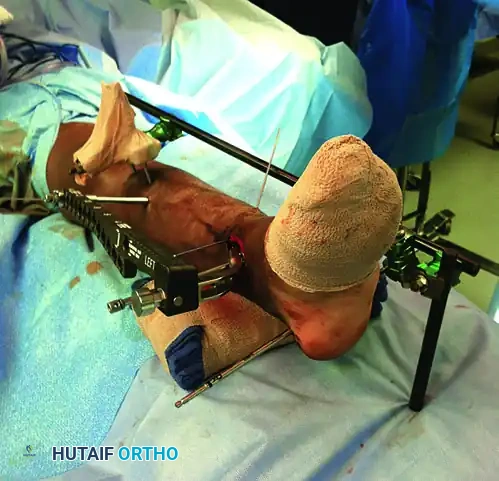 MINIMALLY INVASIVE PLATING OF TIBIAL PILON FRACTURE Surgical Diagram