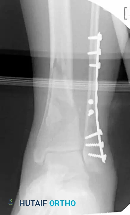 MINIMALLY INVASIVE PLATING OF TIBIAL PILON FRACTURE Surgical Diagram