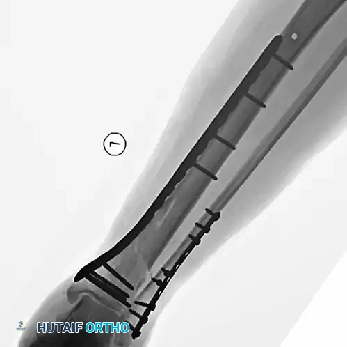 MINIMALLY INVASIVE PLATING OF TIBIAL PILON FRACTURE Surgical Diagram