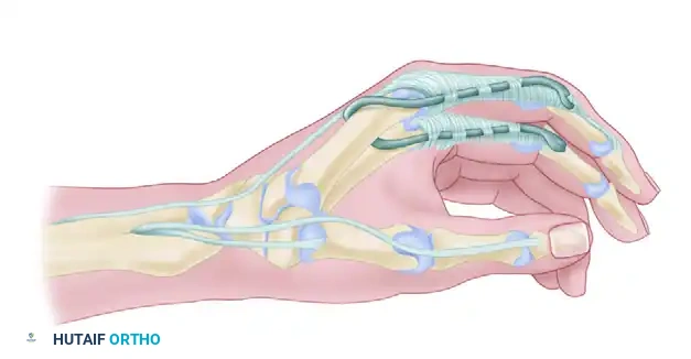 MOBERG KEY GRIP TENODESIS Surgical Diagram