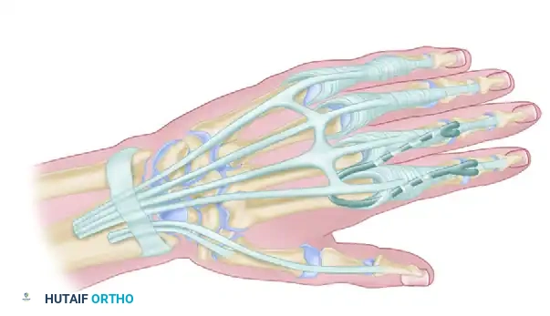 Moberg Key Grip Tenodesis: Surgical Technique & Biomechanics