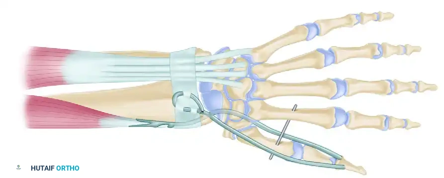 Brachioradialis or extensor carpi radialis longus