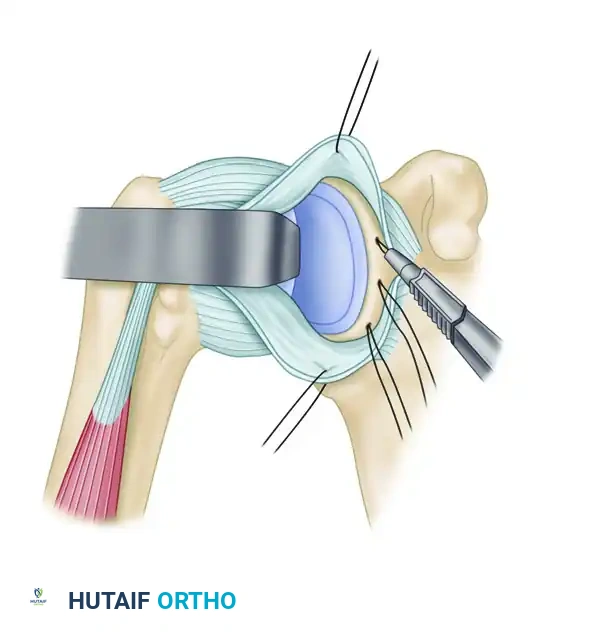 Inferior Capsule Approximation
