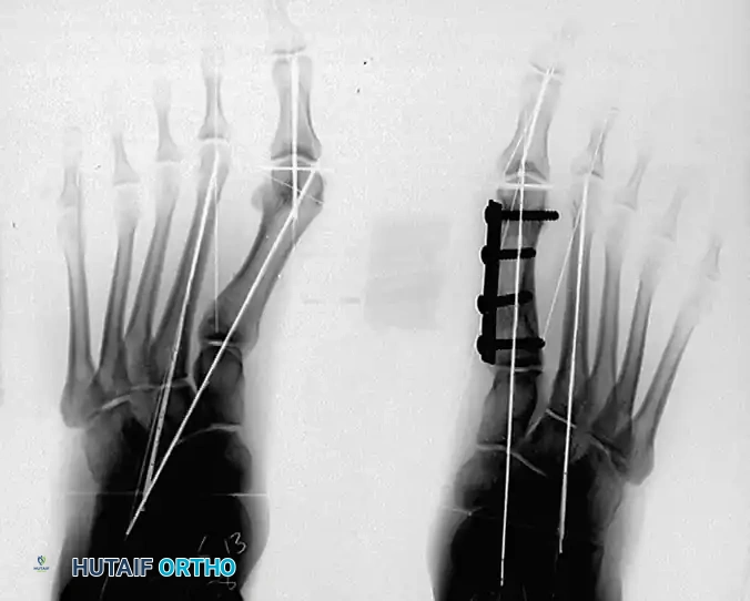 Modified Peterson Procedure: Comprehensive Surgical Guide