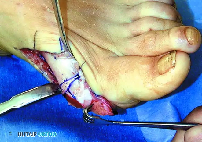 Elevating the Osteoperiosteal Flap