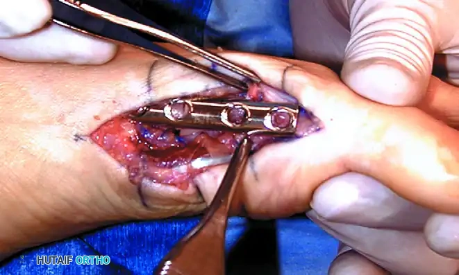 Initial Plate Placement and Fixation