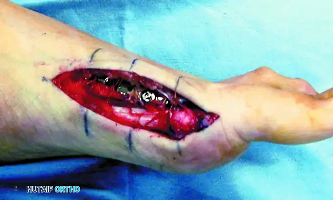 Final Plate Fixation with Flap Integration