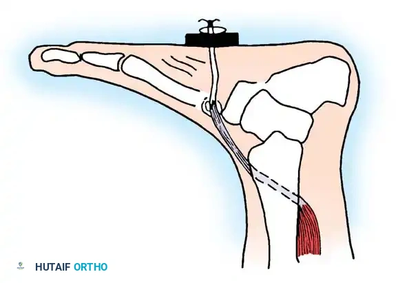 MUSCULAR DYSTROPHY Surgical Diagram